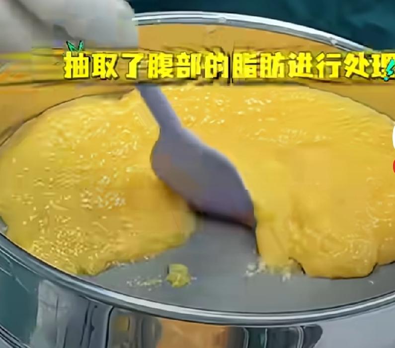 医生在女生身体抽取脂肪后进行处理，处理后直接把脂肪注射到胸部，医生说，这样不用