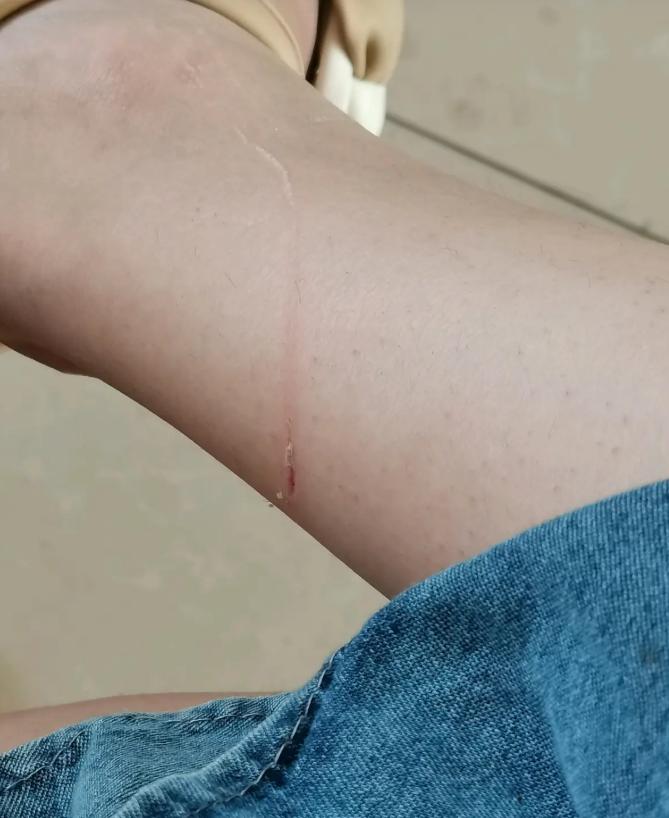 云南，女子在路上途经邻居家门口，突然冲出一只小狗，狠狠咬伤她的膝盖和脚底。事发之