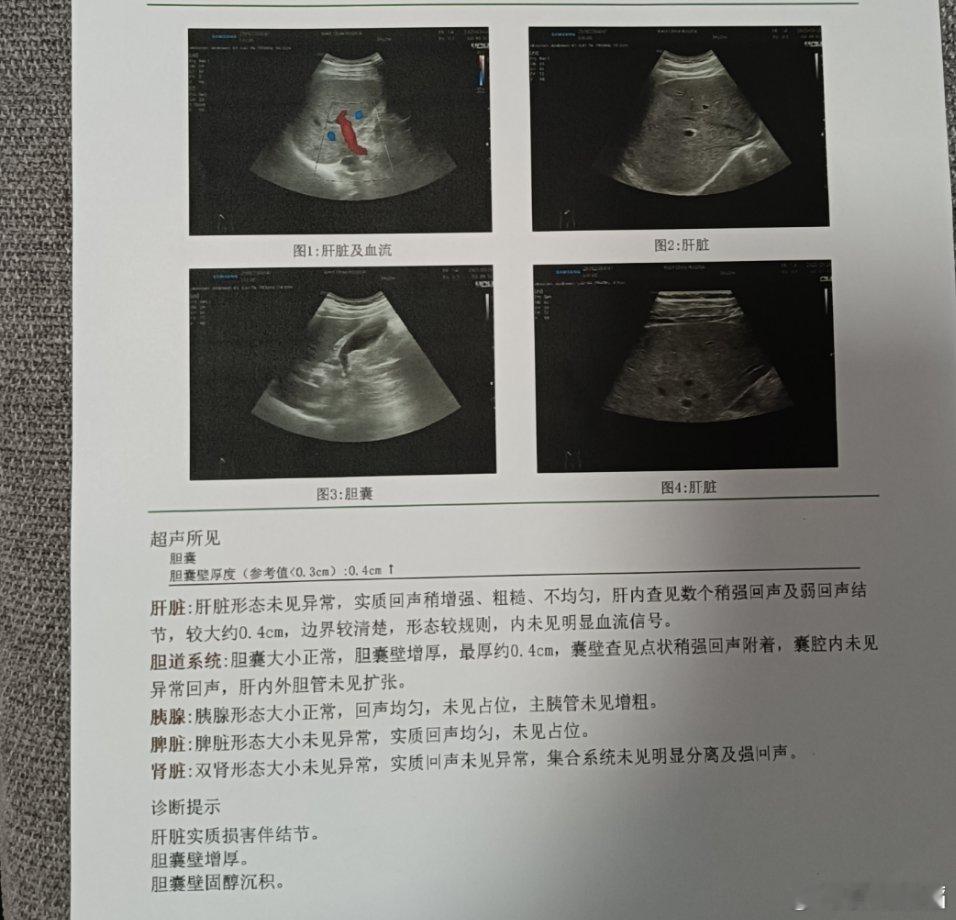 肝脏彩超解读：图一：红色蓝色是血流信号图二、四：越亮表示回声高，越暗表示回声低。