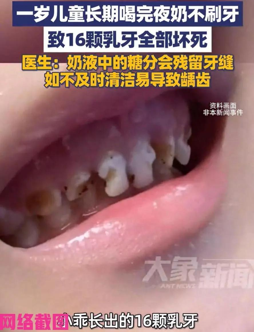 浙江杭州有一岁多的宝宝。只因夜间喝奶不刷牙，而把自己嘴里的乳牙全部坏掉，医生