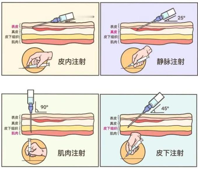 小时候流行的屁股针，剧痛但见效快，为何现在消失了？ 如今去医院，不管是感冒发