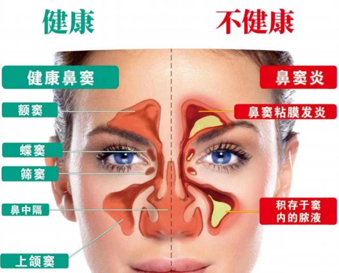 鼻炎总不好？问题出在鼻粘膜上！修复它，比乱吃药管用100倍有没有发现，身边得