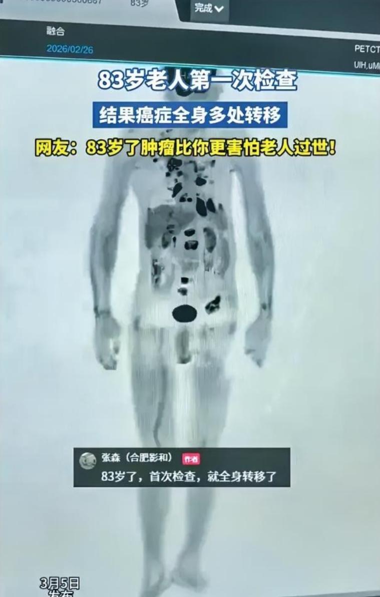 岁数大也有岁数大的好处！安徽，一位83岁老人第一次做全身检查，结果片子上显示，老
