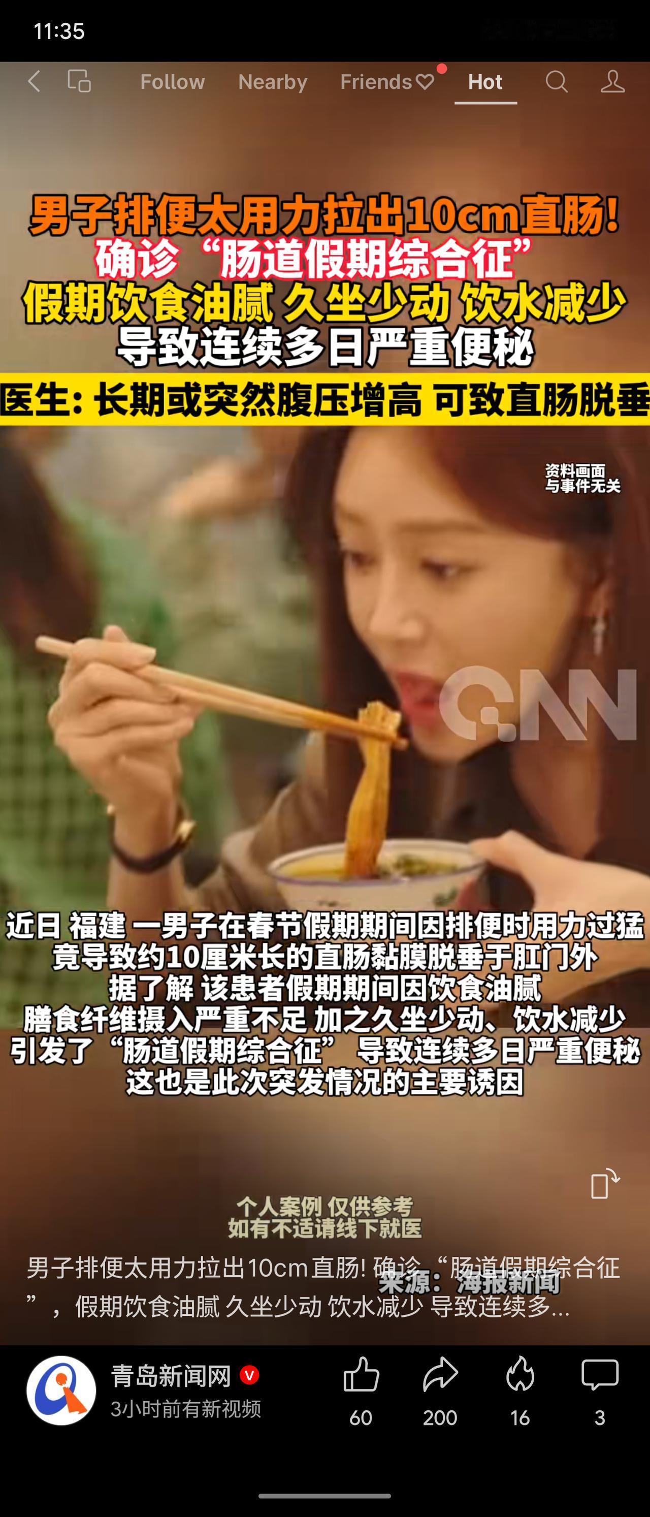 福建一男子因“肠道假期综合征”，排便用力过猛导致约10厘米直肠脱垂。医生提醒，腹