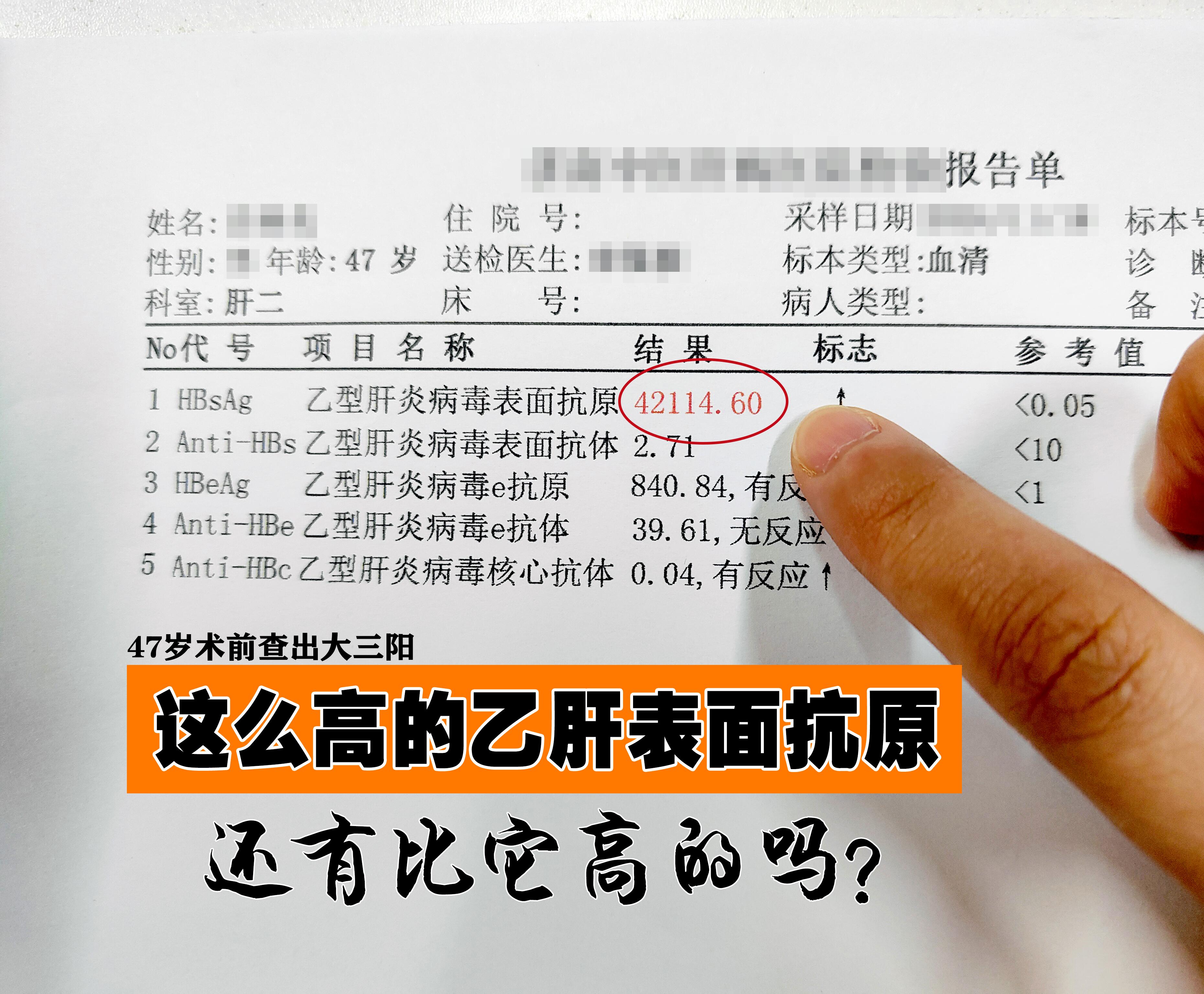这么高的乙肝表面抗原，还有比这个高的吗？ 47岁的李先生因要做髋关节手...