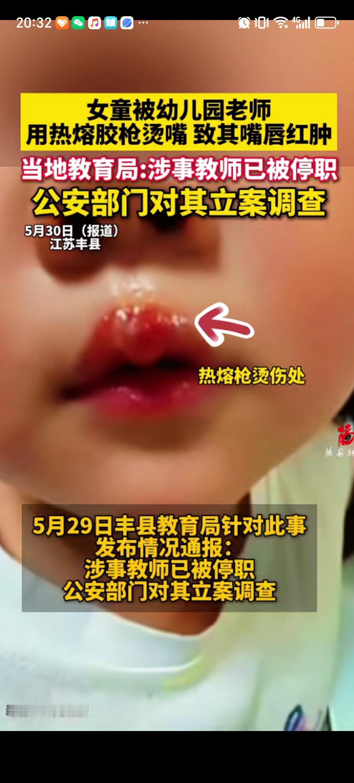 江苏徐州一幼儿园女童因为上课说话，被女老师拽过来，用高温热熔胶枪烫孩子嘴唇，第一