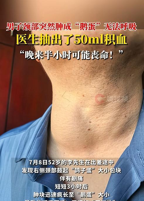 “太可怕了！”7月8日，湖南长沙，一男子出差时脖子突然疼起来，还鼓起鸽子蛋大的肿