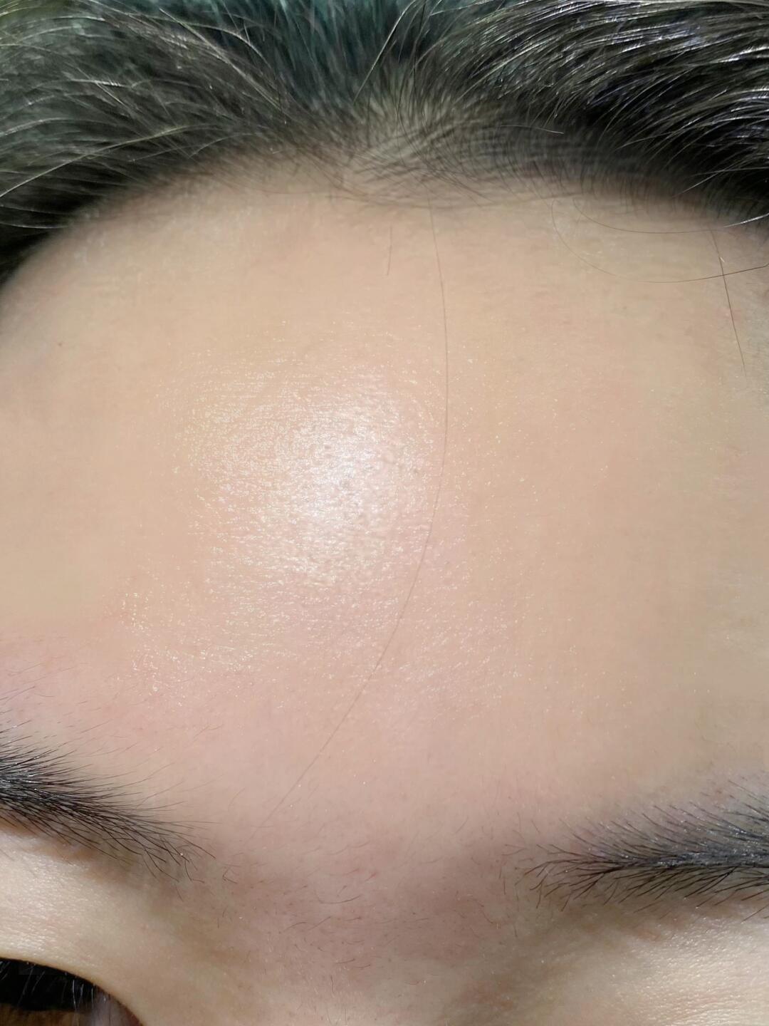 洗掉10斤痘印（生理盐水）