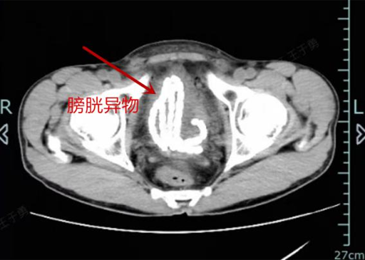 男子尿道里“吸进”30厘米串珠, 忍了3天才取出