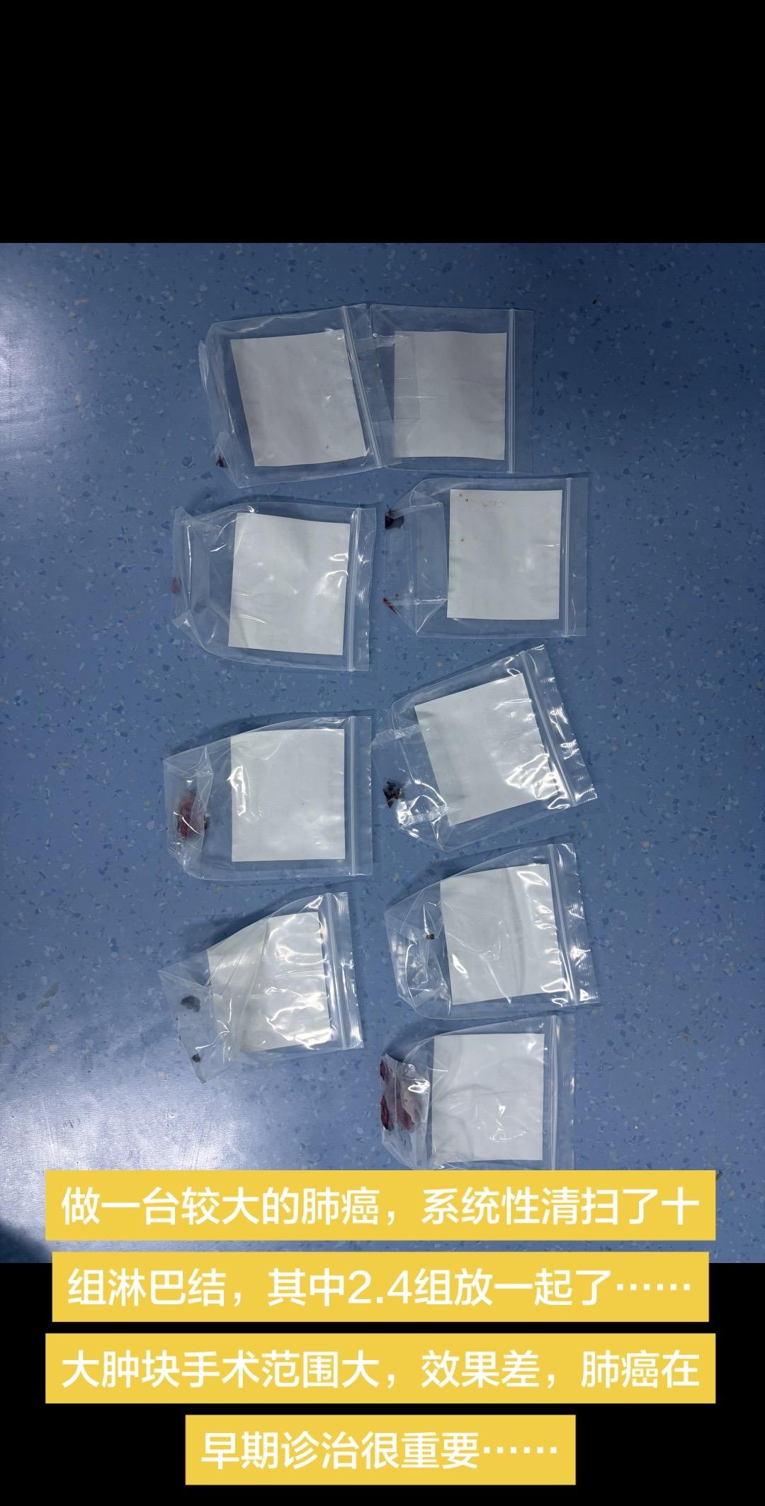 做一台较大的肺癌，系统性清扫了十组淋巴结，其中2.4组放一起了……大肿...