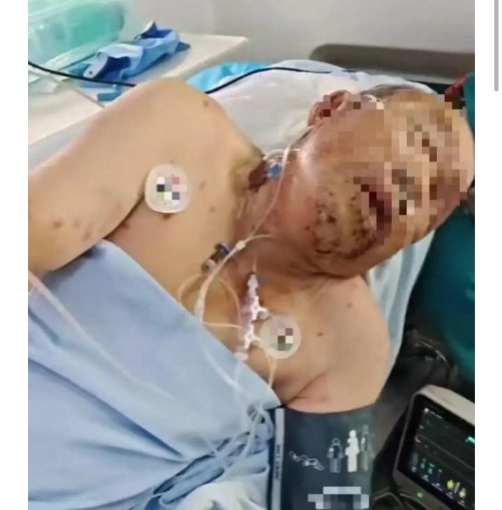 75岁的老人在湖边散步，被胡蜂叮咬200处，最后在医院治疗无效身亡。没有人承