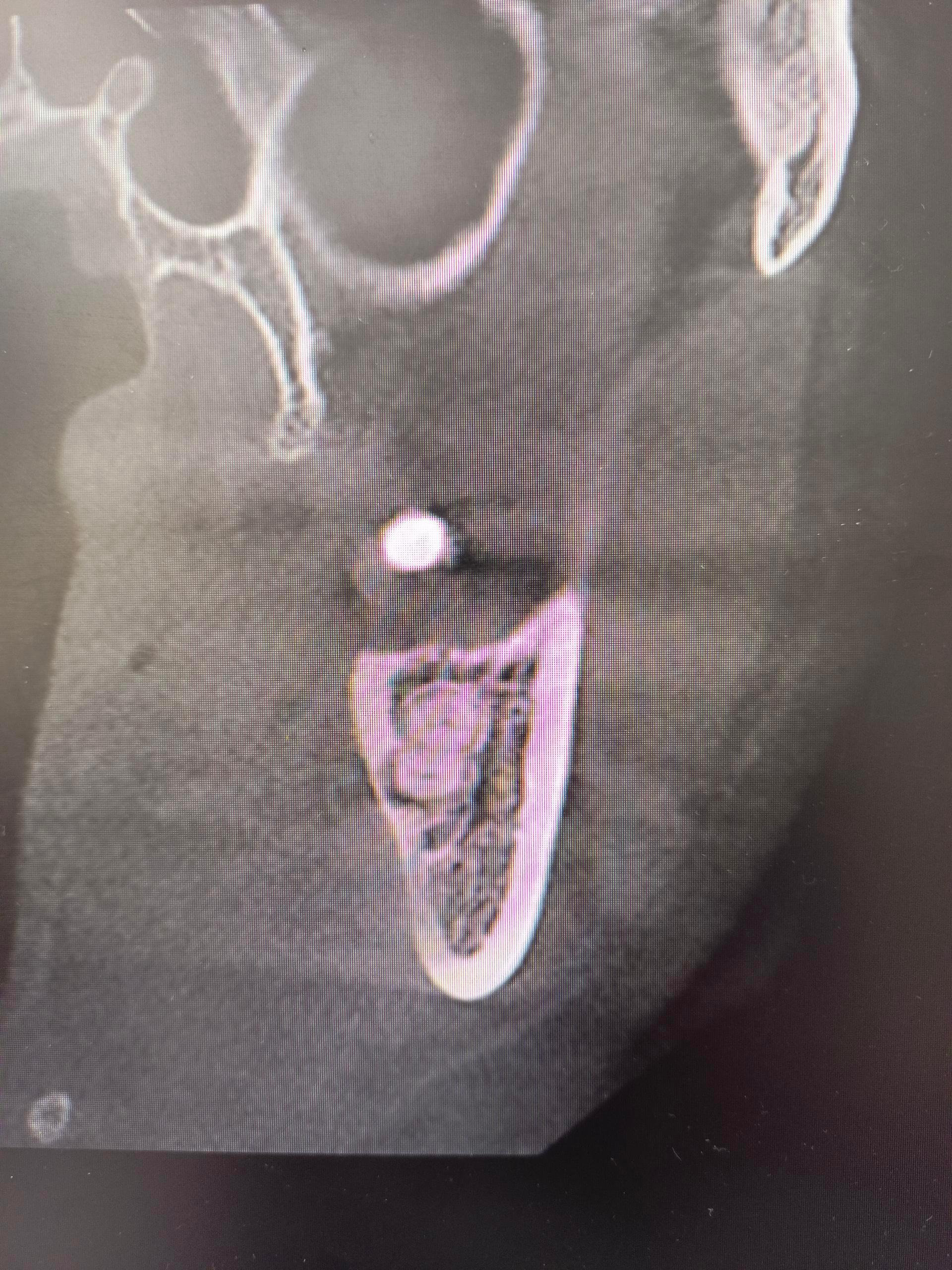 牙科院长来了都不敢拔的牙齿