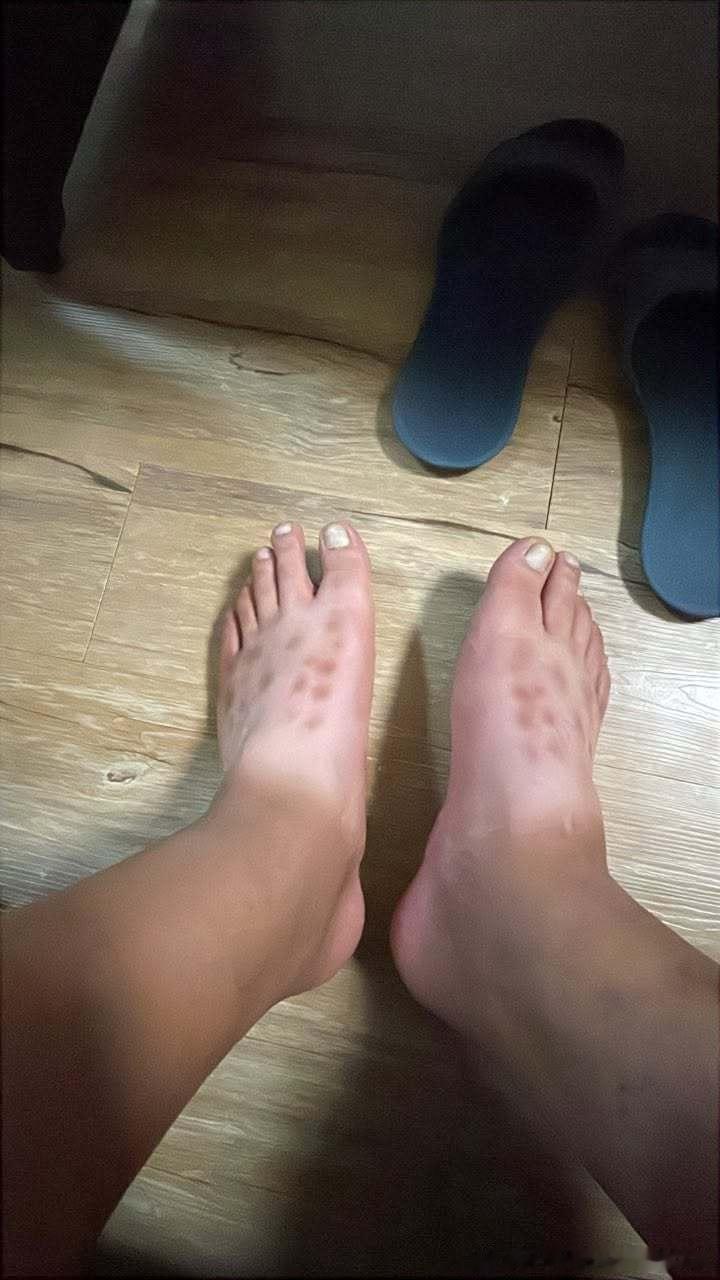 喜欢穿洞洞鞋的人天塌了不穿袜子穿洞洞鞋真是灾难，光脚出汗后，皮肤与塑料材质摩擦