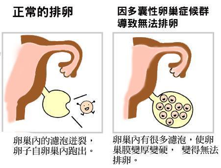 多囊缠身, 真的就与好孕无缘了吗?