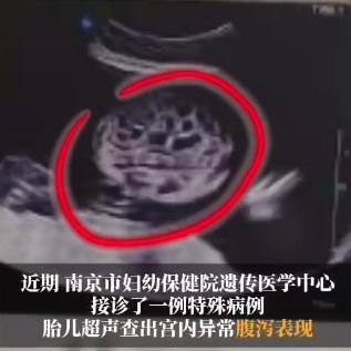 "太离奇了！"江苏南京，一位29岁孕妈小文在孕24周+3天做常规产检时，B超探头