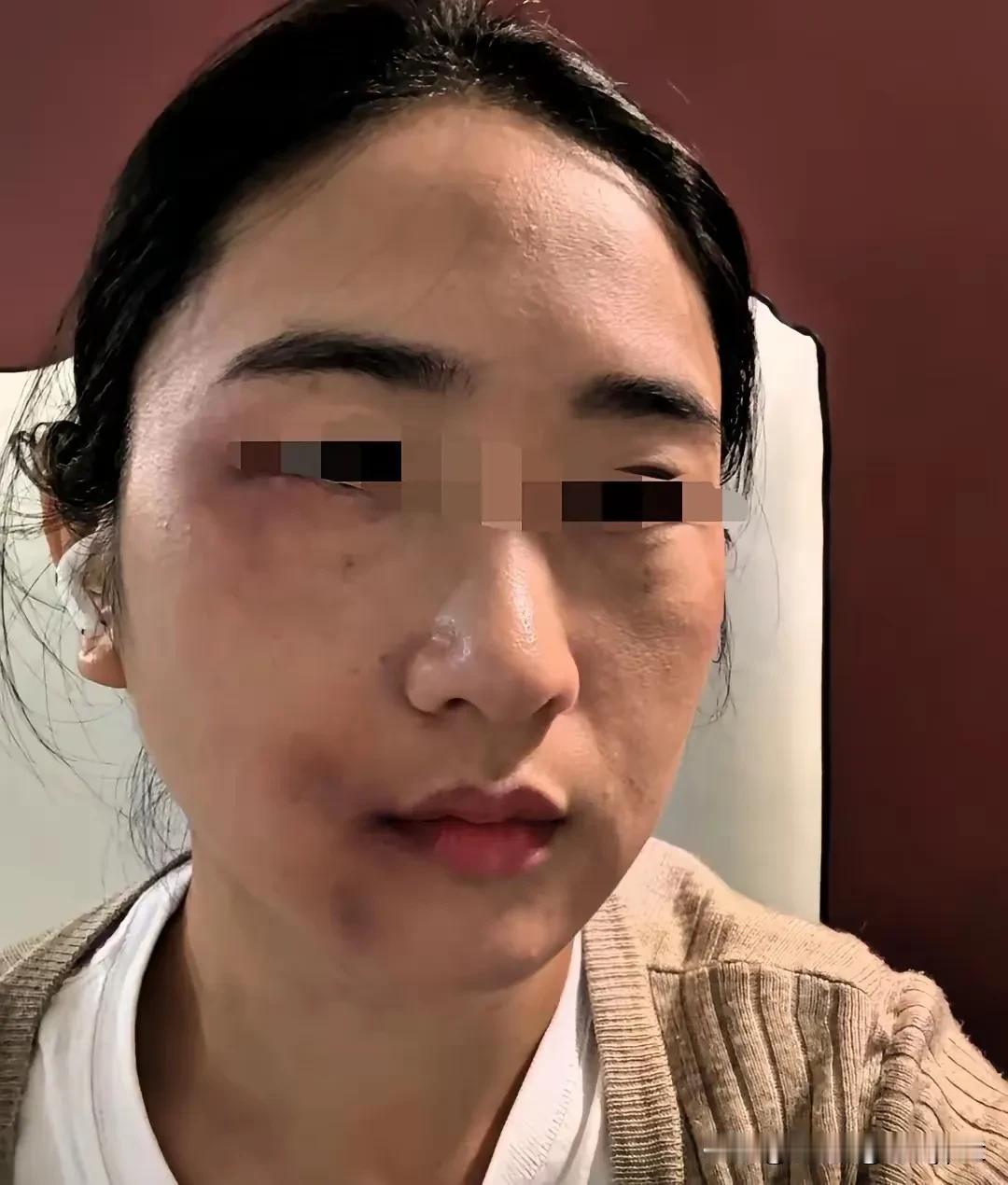 为这位女子伤感！被丈夫多次殴打，最后告诉弟弟。弟弟抄起钢管上门，打断丈夫一根肋骨