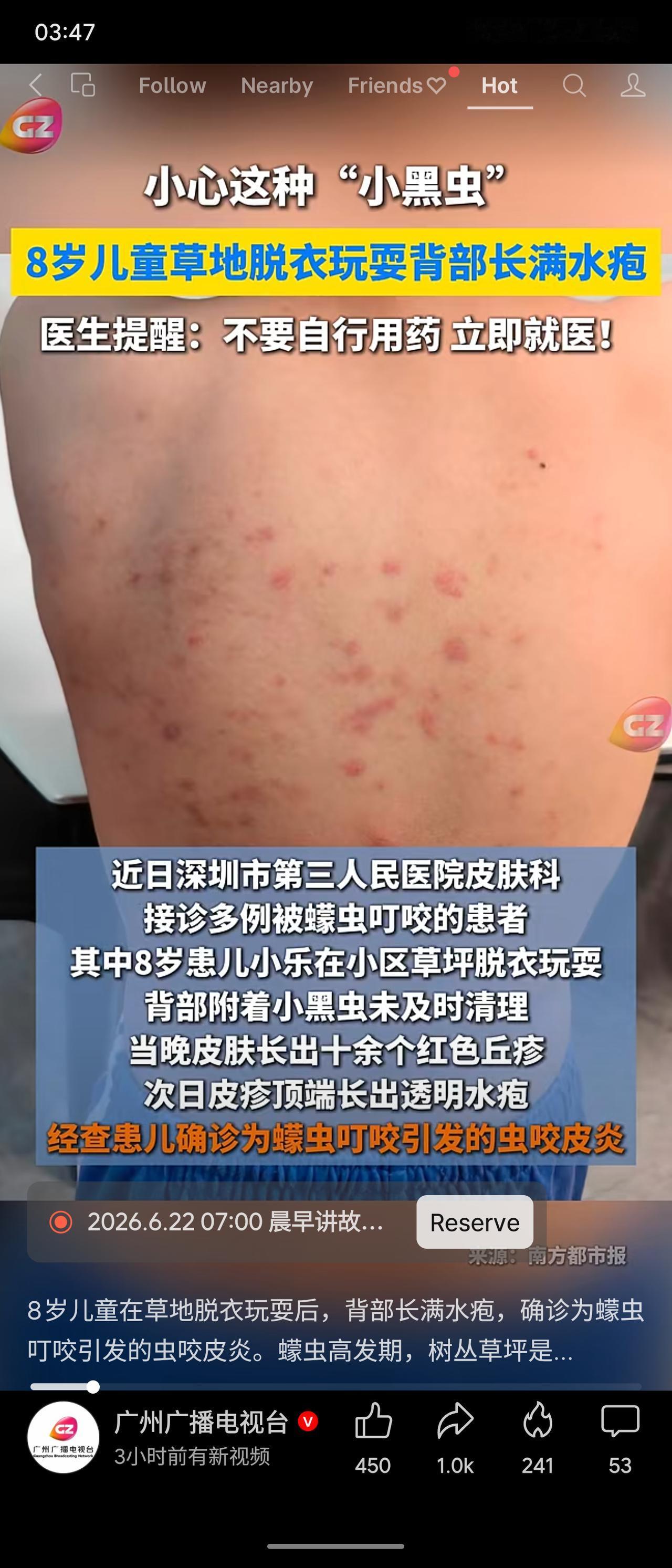 8岁儿童在草地脱衣玩耍后，背部起满水疱，确诊为“小黑虫”（蠓/蜱类）叮咬所致虫咬