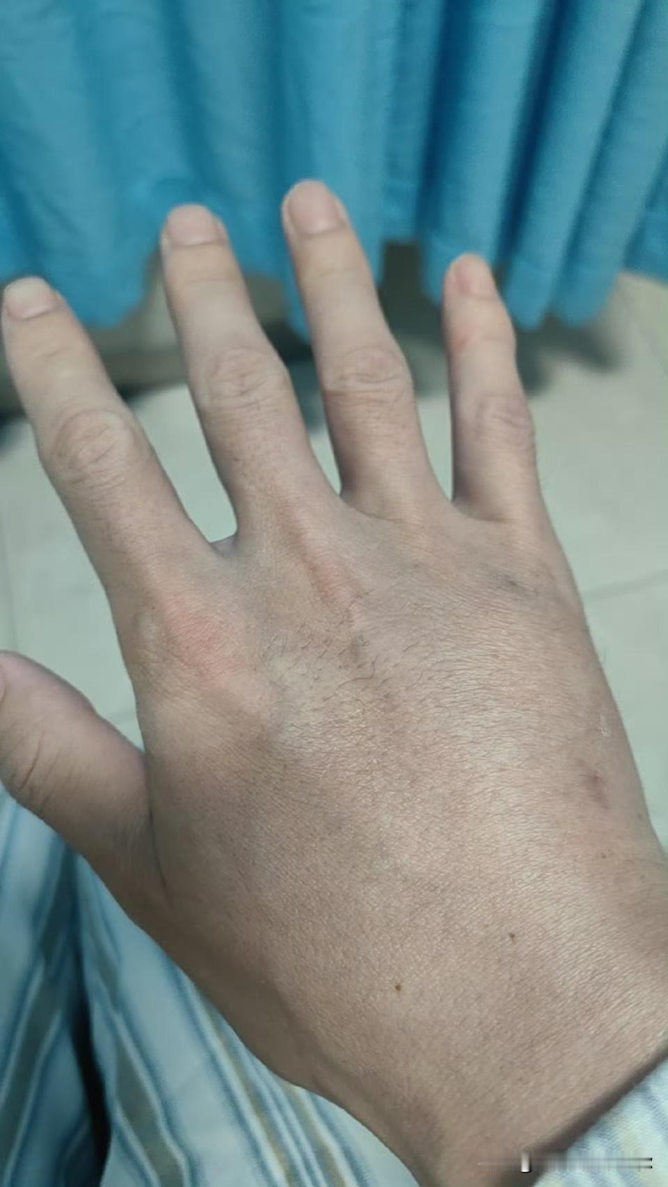 肿瘤医院的输液港，现在不住院了。不是因为医院床位突然变多了，和因为化疗流程