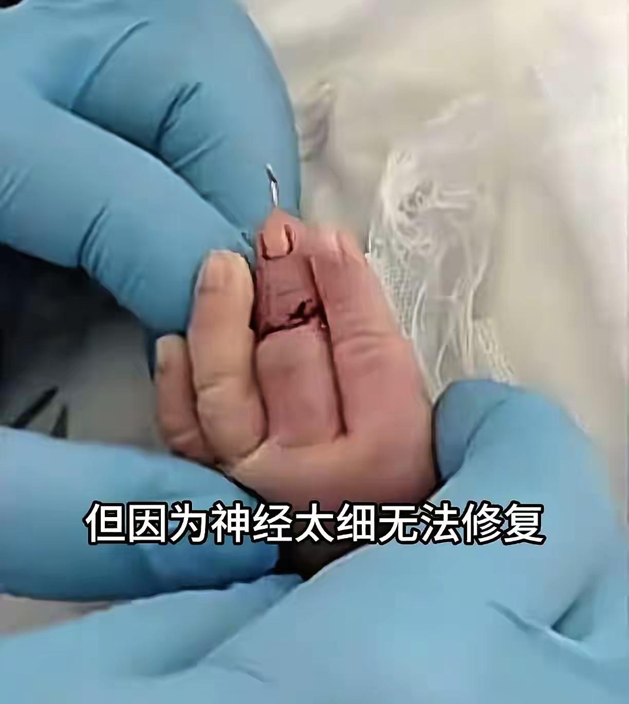 江苏新生儿剖宫产手指被剪，院方先甩锅再赔10万？家属不接受！江苏盱眙这起新