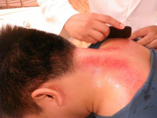 失眠有救了! 中医刮痧疗法很关键