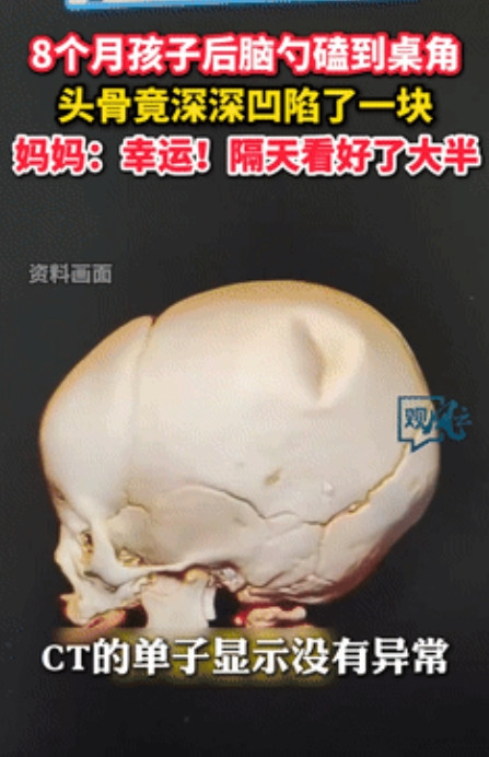 人类幼崽的自愈能力！”8个月婴儿从沙发摔下，后脑勺竟磕出一大凹坑！可万万没想到，