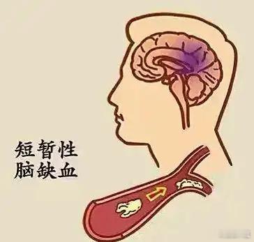 什么是，小卒中？小卒中，简单说就是，一过性脑供血不足。也可以说小卒中是，轻度脑梗