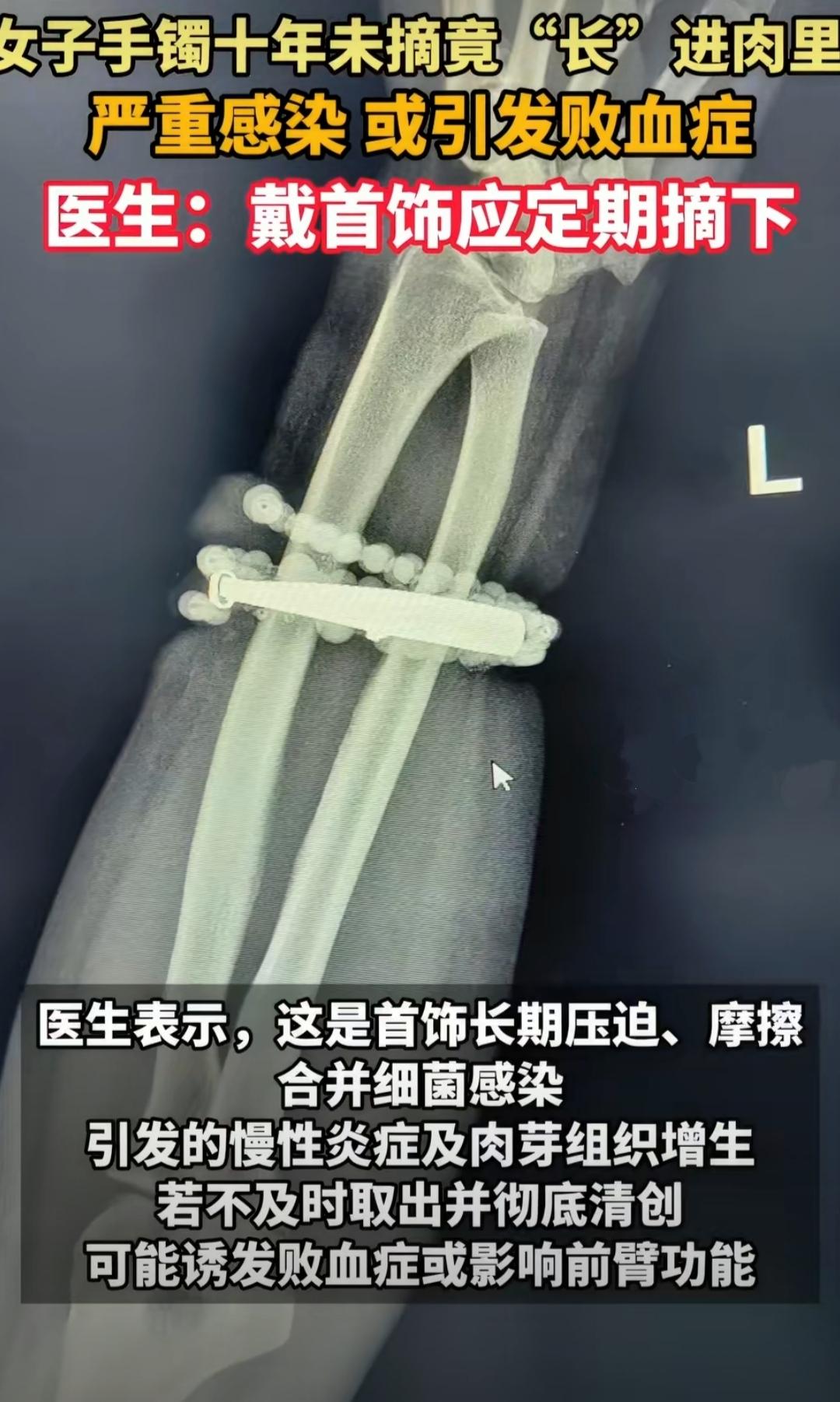 最近福建宁德的一则医疗新闻看得人头皮发麻：33岁的龚女士戴了十年的银手镯，硬生生
