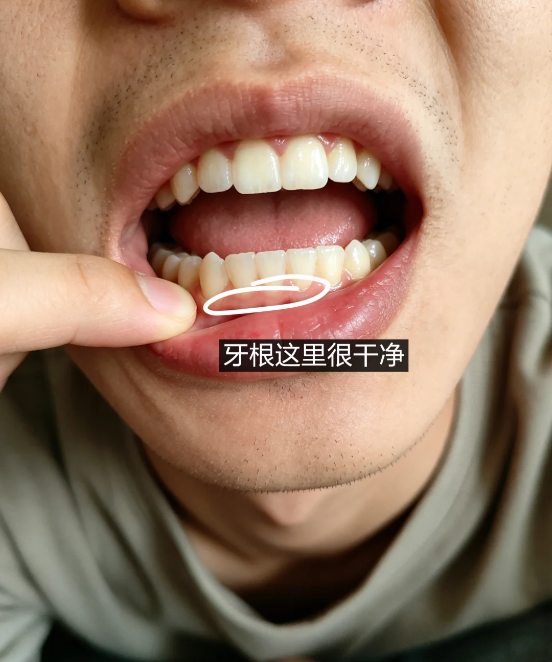 把牙弄干净真没那么难吧