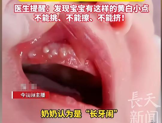 “福大命大！”近日，陕西西安，一女子发现自己两个月大的孩子牙床上有个小白点，奶奶
