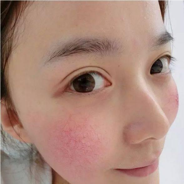 红血丝如何祛除?