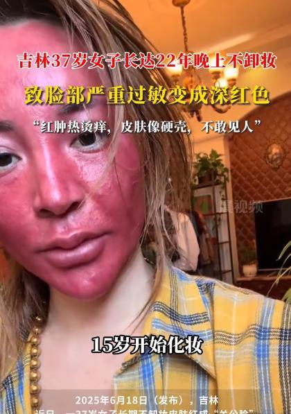 悲剧还是发生了！吉林37岁女子因为太懒，22年来从不卸妆，如今脸部严重过敏红的吓