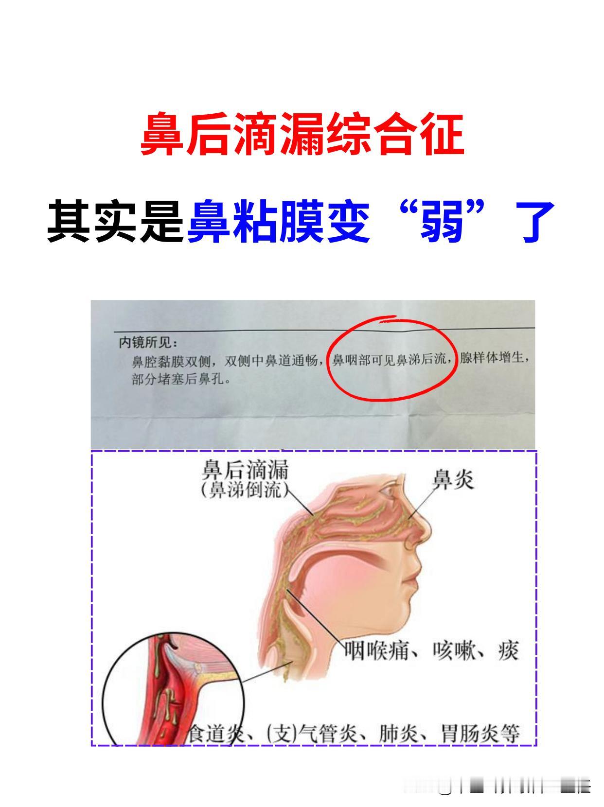 鼻后滴漏综合征，其实就是鼻黏膜变“弱”了。 不少前来就诊的鼻涕倒流患者都满心