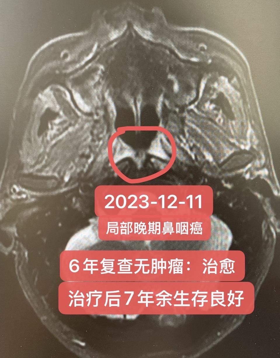 局部晚期鼻咽癌：治愈经验分享。48岁，男，分期：T2N3bM0 → I...