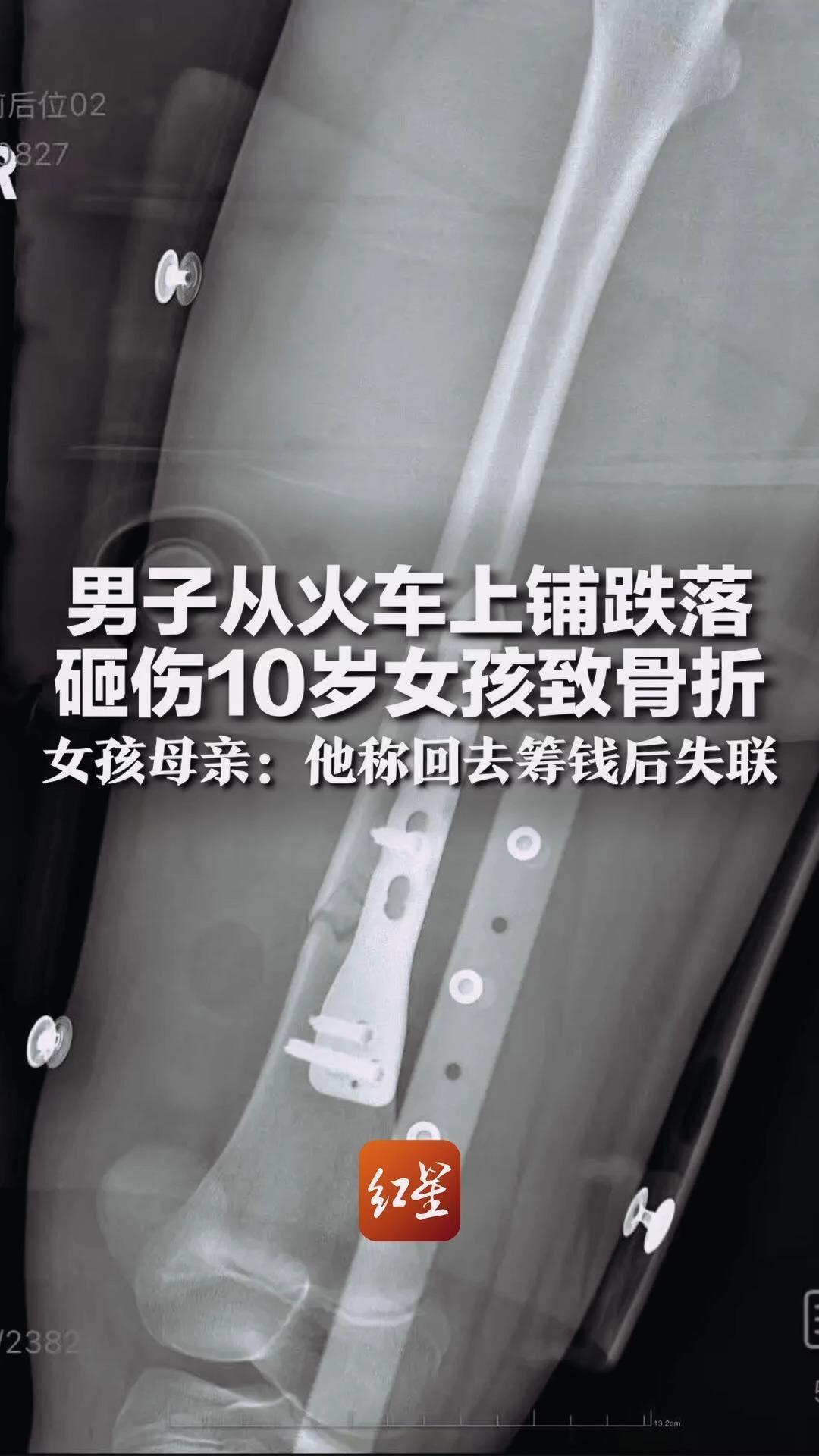 最近，“列车上铺男子跌落砸断10岁女孩腿骨”一事闹得沸沸扬扬，话题仅6小时阅读量