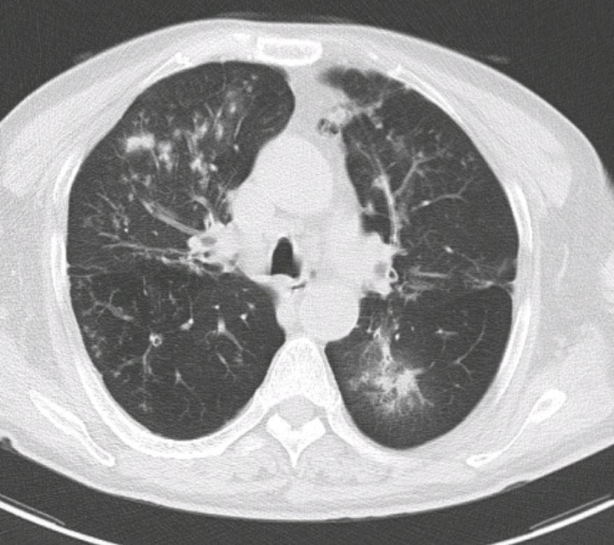 两个信号，说明你的肺结节，不能再拖了！第一：结节相关症状突然出现或加重如果