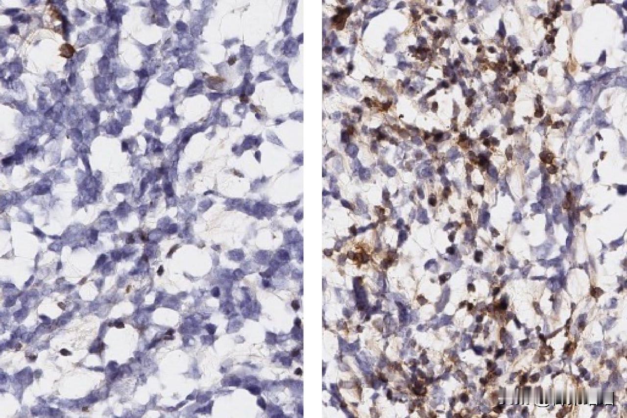 麻省理工学院研究人员发现胶质母细胞瘤的新免疫治疗靶点麻省理工学院研究人员在F