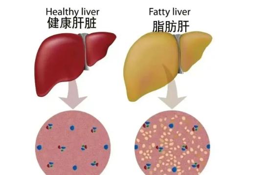 一个中成药，堪称“肝脏的修复剂”！对症了，肝功能或越来越好！在现代社会高糖高