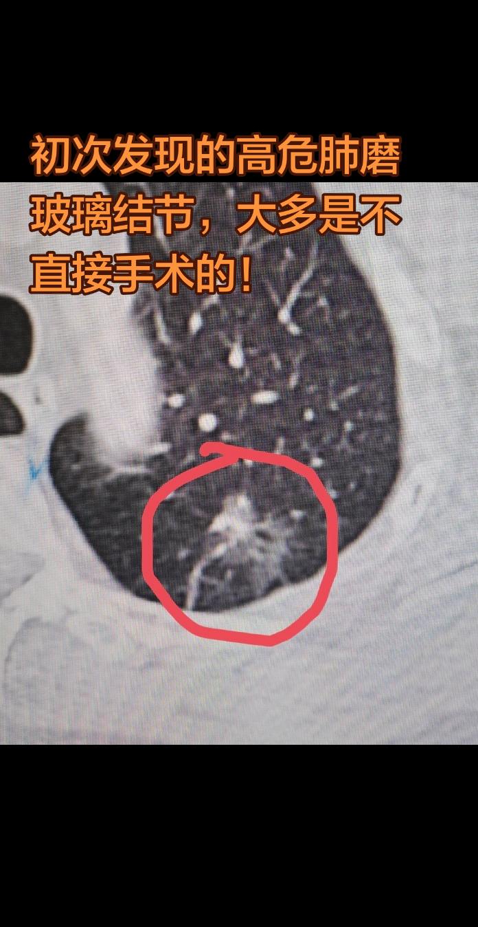 初次发现的高危肺磨玻璃结节，怎么办？初次发现的高危肺结节，有些不建议直...