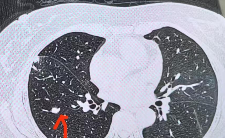 门诊印象最深的是，是有几位得过肿瘤的朋友，又发现了肺结节。第一反应往往是：这些结