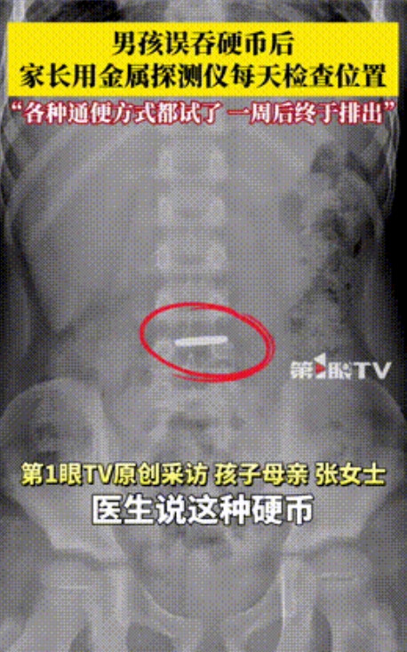 “聪明人就是点子多！”河南郑州，一男孩不慎将1元硬币咽了下去，在家长发现后，立马