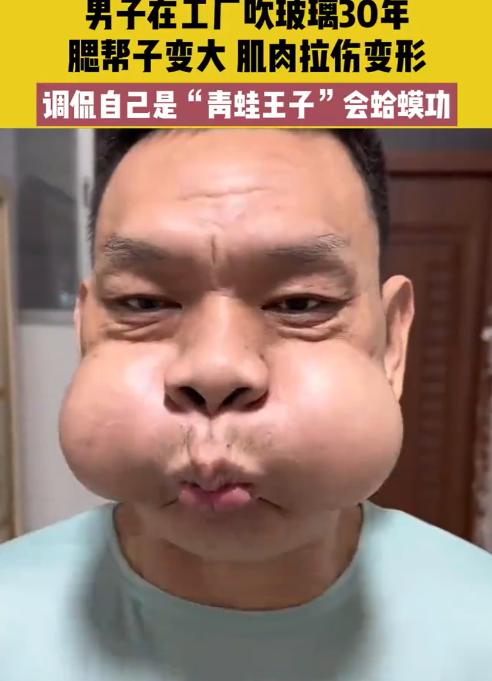 这个真笑不出来！广东一男子在工厂干活干了30年，因为常年都要吹玻璃，导致两个腮帮