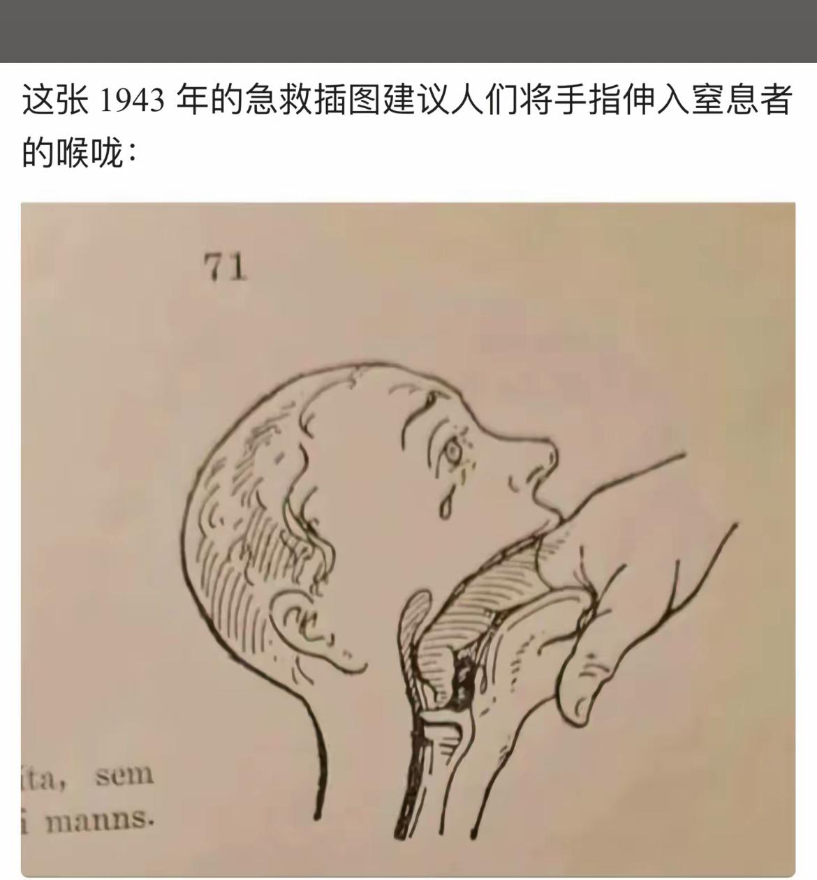 1943年急救插图：手指进喉窒息急救法