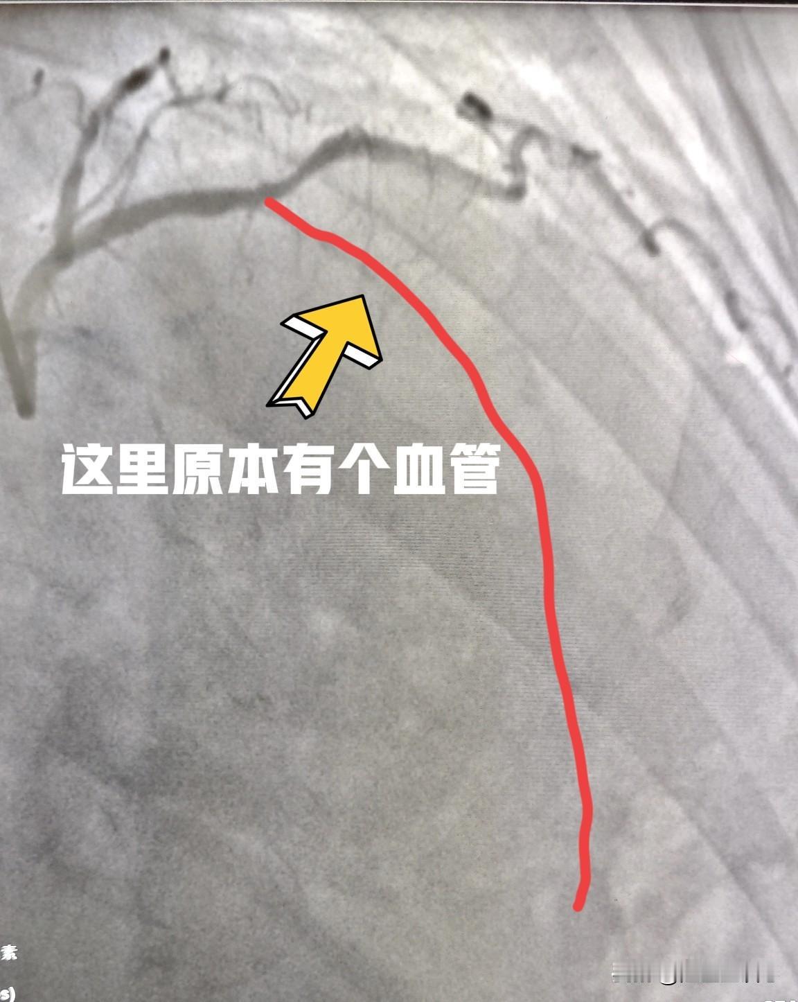 终于下班了，堵塞血管开通又一例，成就感满满。68岁女性，胸痛2周，做心电图怀