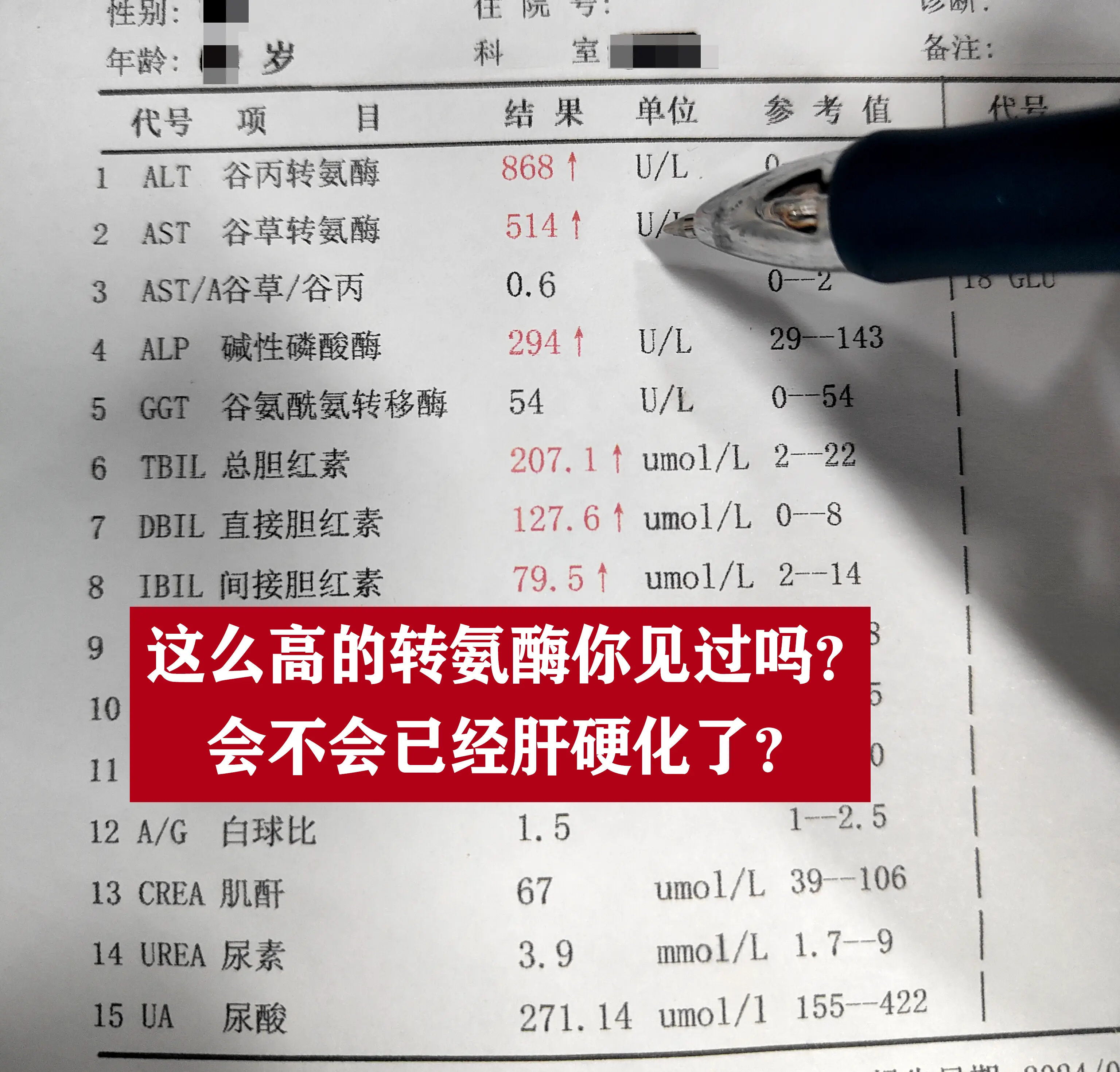 小伙子，你这个严重肝损伤了，你吃恩替卡韦10年了，尽管HBV DNA持...