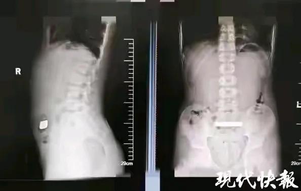 “惊险一刻：11岁男孩吞金条，背后隐藏的家庭教育真相！”苏州11岁男孩小钱（在