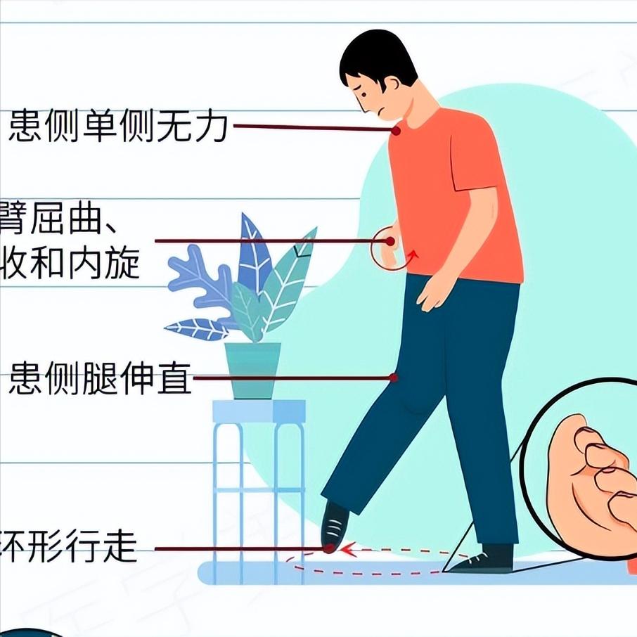 偏瘫走路经常会面临得6大问题，你中了几个？偏瘫后走路，很多人以为只是“走得慢