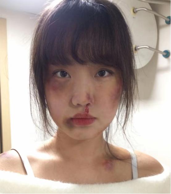 四十二岁的李娟刚挨完丈夫的皮带毒打，满身伤痕还没养好，婆婆就上门逼着她大度忍让。