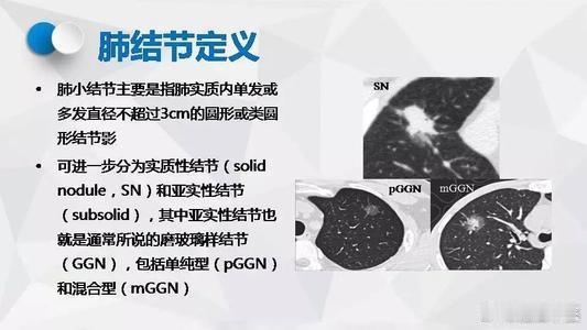 肺结节早期的5个信号；1，持续咳嗽或咳痰：持续频繁地咳嗽，且痰量增多，可能是肺结