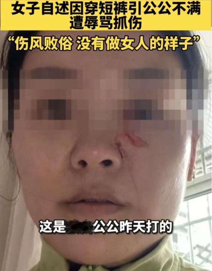 四川徐女士，因为天太热，穿了条牛仔短裤，公公就骂她不要脸、就为这事还把她脸抓伤了