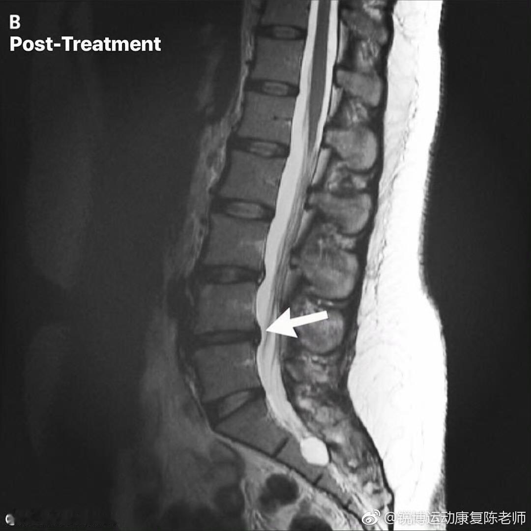 来看个腰突对比——这两张核磁片子，就可以清楚的看到椎间盘膨出（图1）和椎间盘突出